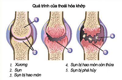 Nguyên nhân của thoái hóa khớp